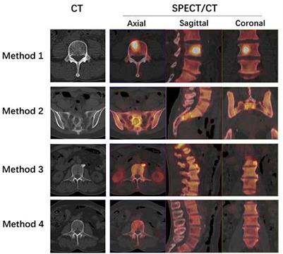 Skeletal standardized uptake values obtained using quantitative SPECT/CT for the detection of bone metastases in patients with lung adenocarcinoma